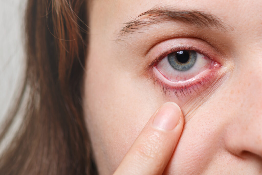 ardencia-nos-olhos-cilios-nos-olhos