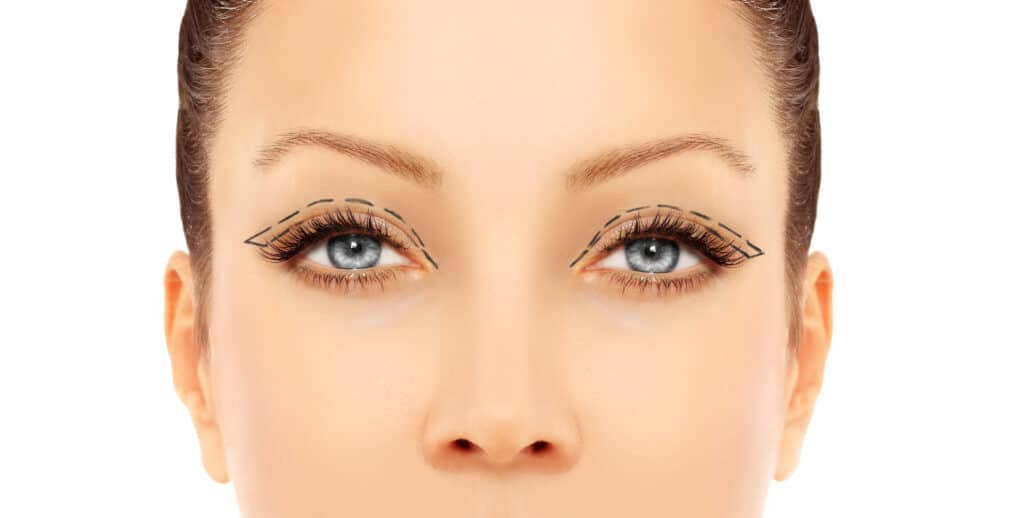 Cicatriz de blefaroplastia