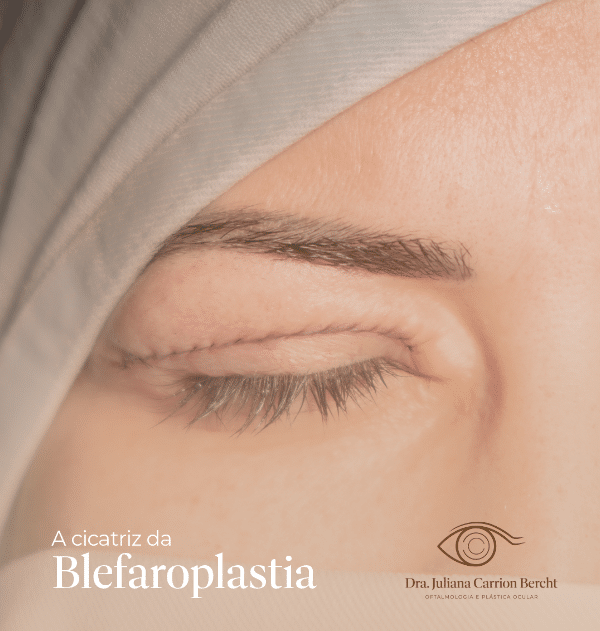 Cicatriz de blefaroplastia: saiba tudo sobre o pós-operatório