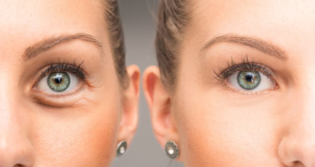 Como acabar com rugas ao redor dos olhos com a blefaroplastia