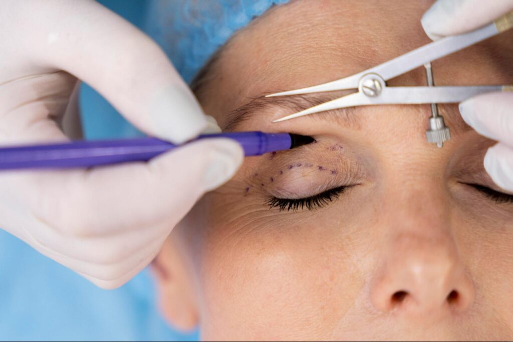 PDRN - blefaroplastia